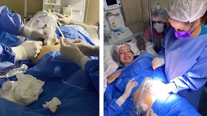 En la izquierda, la médica recibe una aguja mientras le realizan un ultrasonido al feto para encontrar el tumor. En la derecha, Polyana, reccibe la aguja que será utilizada para quemar el tumor