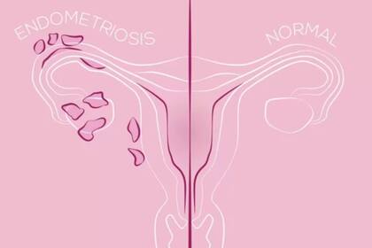 En la mayoría de las mujeres, los síntomas de la endometriosis desaparecen después de la menopausia