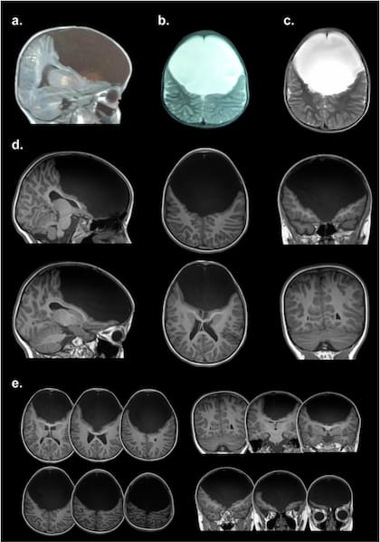 En la parte superior de la resonancia magnética, se observa la parte faltante de la masa cerebral