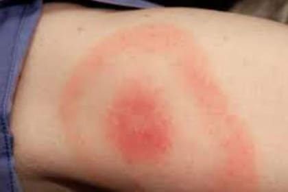 En la primera etapa de la enfermedad puede aparecer una lesión en la piel