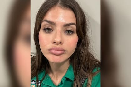 En las imágenes que compartió se puede observar un moretón en la zona del tabique (Foto Instagram @sangrejaponesa)