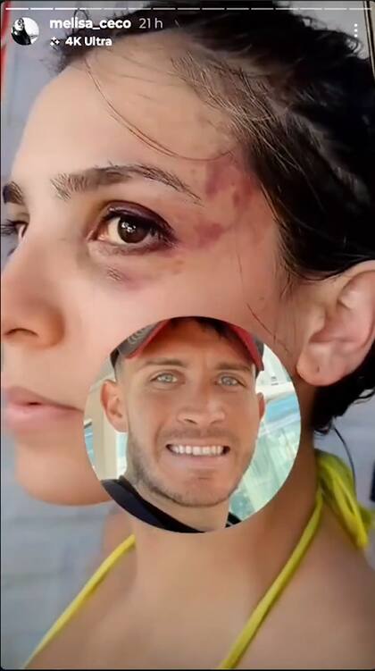 En las imágenes se pueden ver heridas en la cara y en el cuello de Emily (Captura: Instagram @melisa_ceco)