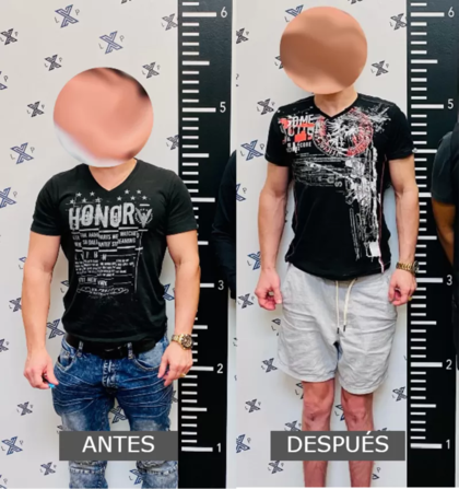 En las operaciones se pueden ganar hasta ocho centímetros