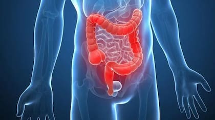 En los últimos años, la incidencia de cáncer de colon aumentó precipitadamente entre las personas menores de 50 años