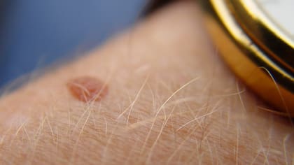 En promedio, una persona tiene 20 lunares en todo el cuerpo