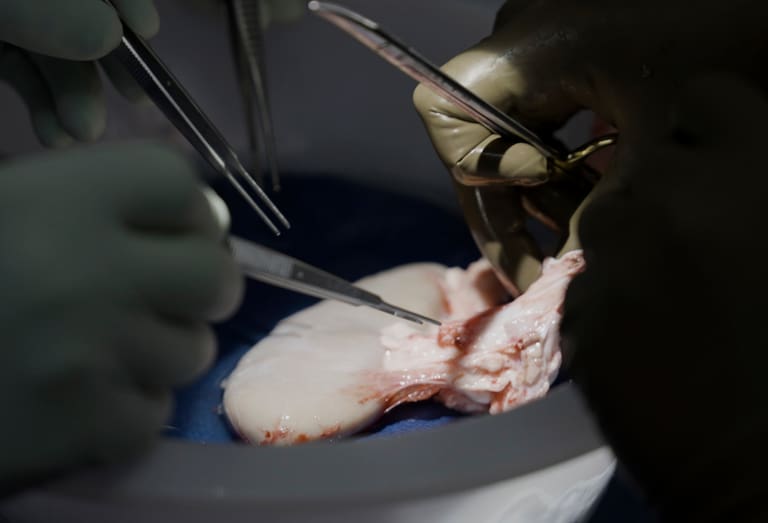 Hito: cómo fue el procedimiento para trasplantar el riñón de un cerdo a un humano y qué implicancias tiene para la medicina