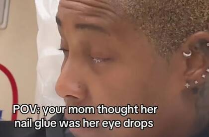 En un descuido, confundió un frasco de pegamento para uñas con sus gotas oftálmicas