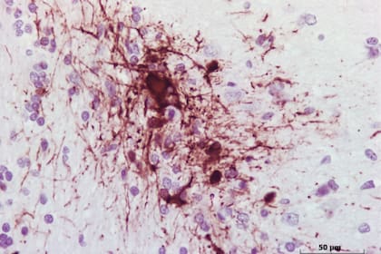 Encéfalo de tejón donde se observa el virus del moquillo canino (en rojo) en el interior de las neuronas. Tinción de inmunohistoquímica