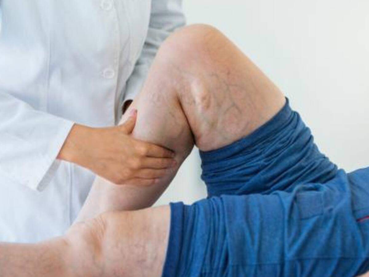 5 Errores que Pueden Arruinar la Salud Vascular de tus Piernas