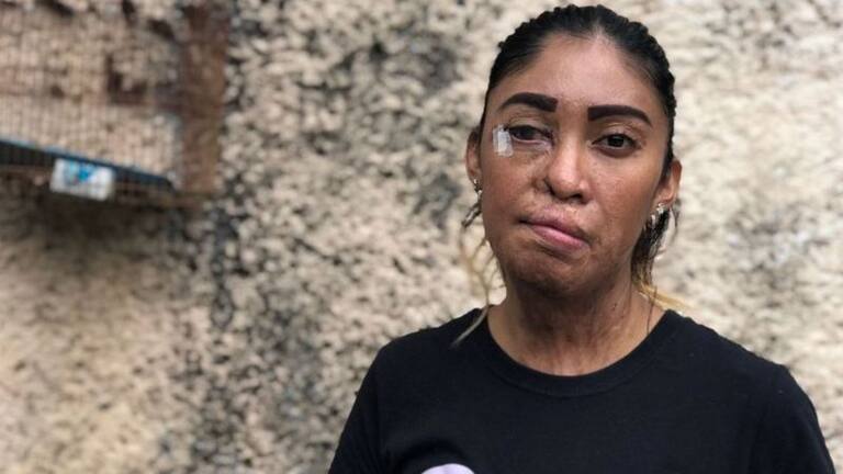 La historia de Esmeralda Millán, víctima de los ataques con ácido en México - LA NACION