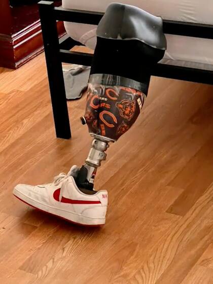 Esta es la prótesis que le perdieron en la aerolínea de EE.UU.