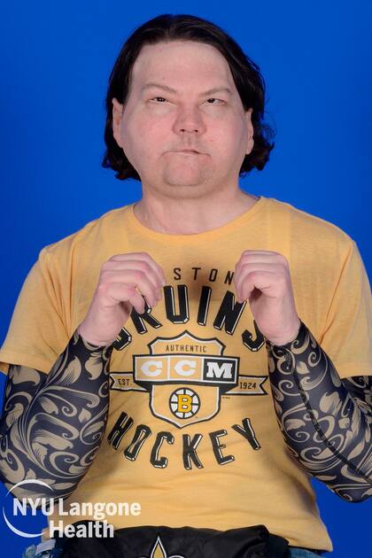 Esta imagen sin fecha, cortesía de NYU Langone Health, muestra a Joe Dimeo recuperándose después del trasplante de cara y manos.