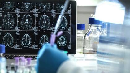 Estados Unidos aprobó un nuevo fármaco para atacar las causas subyacentes del alzhéimer