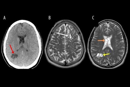 Estas imágenes permitieron detectar la presencia de las larvas de tenia en el cerebro del paciente.