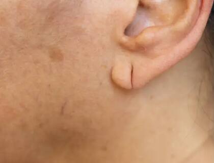 Estos son algunos de los cambios que pueden percibirse en los lóbulos.