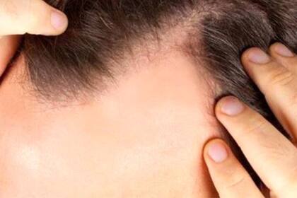 Estudios académicos abordan la relación entre la caída del cabello y la covid-19, pero las causas, la duración y los tratamientos todavía no están muy claros