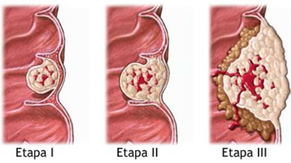 Etapas del desarrollo del CCR