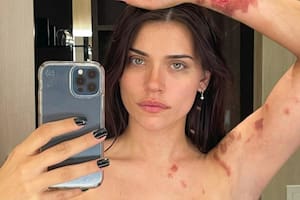 Eva De Dominici mostró por primera vez las fotos de las quemaduras que tuvo tras un accidente doméstico