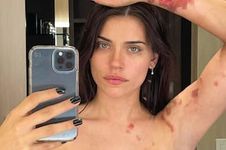 Eva De Dominici recordó su doloroso accidente y mostró las impactantes fotos