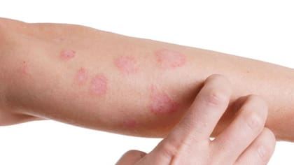 Existen distintas alergias que afectan la dermis