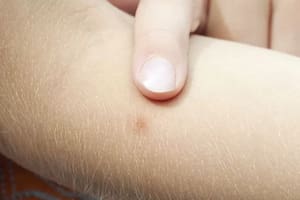 Existen más de 2500 especies de mosquitos, los cuales son transmisores de enfermedades tan perjudiciales como la malaria.