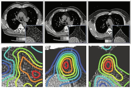 Explicabilidad: Mapas de prominencia. Imágenes representativas de tomografía computarizada de la cohorte FHS superpuestas con los mapas de prominencia generados mediante oclusión, utilizando la característica más importante, que resalta las regiones del timo en las que se centra el modelo al realizar sus predicciones. Los mapas de prominencia se muestran en el corte central del timo, y la escala de color del chorro se utiliza para indicar la intensidad de la contribución