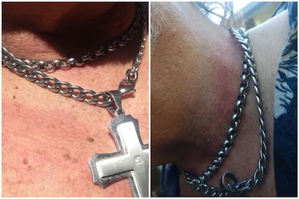Fabio compartió con LA NACION las imágenes de su cuello luego de ser increpado por Gustavo Sofovich