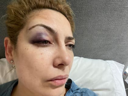 Fabiola Yañez con el ojo derecho morado