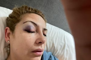 Fabiola Yañez, con un moretón
