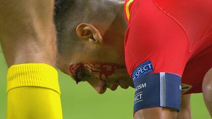 Falcao sufrió un corte sobre la ceja izquierda y jugó con la cabeza vendada la mayor parte del partido