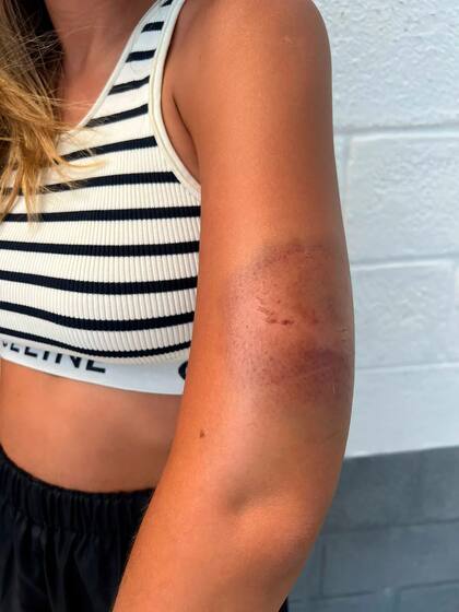 Florencia Sosa terminó con un brazo herido