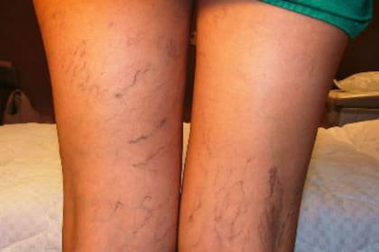 Las várices pueden aparecer tempranamente en las piernas o distintas partes del cuerpo