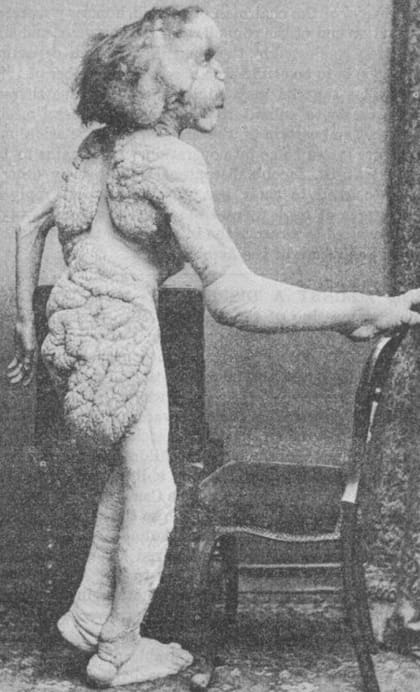 Frederick Treves analizó exhaustivamente a Joseph Merrick y tomó imágenes de su cuerpo para intentar encontrar un diagnóstico, pero nunca pudo hallarlo