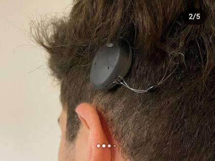 “Gracias al implante tengo la habilidad de escuchar si me hablan de los dos lados y encima a un volumen más cercano a lo normal".