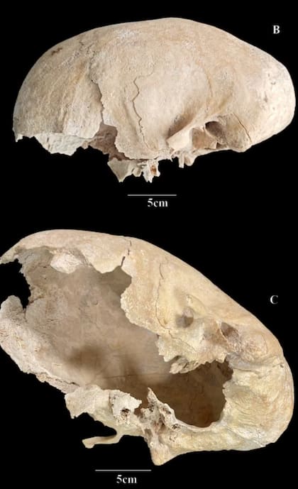 Hallazgo: el cráneo encontrado presentaba una rara anomalía genética
