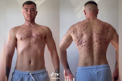 Hartrey aseguró que las ya no siente dolor en las marcas que presenta en su cuerpo, pero que en ocasiones le producen un constante picor.