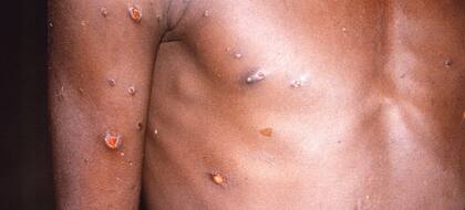 Hasta el momento no hay una vacuna específica para la viruela del mono