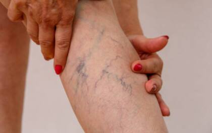 Hay actividades que favorecen la proliferación de varices (Foto: El Tiempo)