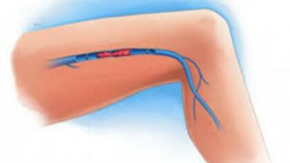 Hay medidas que se pueden tomar para reducir su aparición