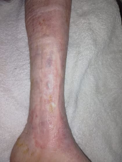 Hay pacientes del Hospital Muñiz que ya llevan 22 meses desde el trasplante del sustituto cutáneo, con recuperación completa de una úlcera que no respondía a tratamientos