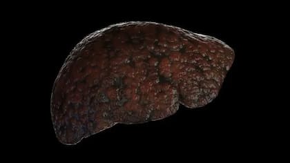 Hay una serie de factores que pueden dañar el hígado, desde virus hasta exceso de grasa