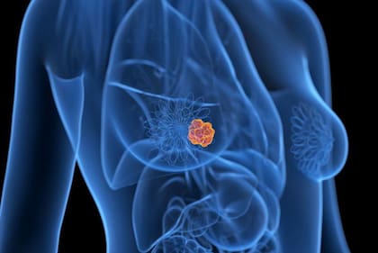 Pacientes de cáncer con tumores inferiores a los 15mm tienen una tasa del 90% de supervivencia durante los siguientes cinco años.