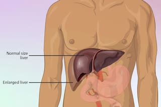 Hígado graso: las estrategias naturales más efectivas para reducirlo y mejorar la salud desde casa
