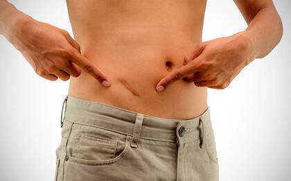 Hombre se cansó de esperar un diagnóstico médico y se operó con tutoriales de YouTube