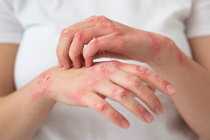 Hongos en la piel: aprenda a identificarlos, sus causas y cómo tratarlos