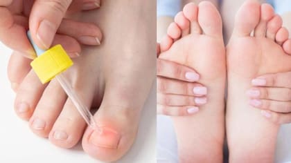 Hongos en las uñas del los pies (Foto: iStock)