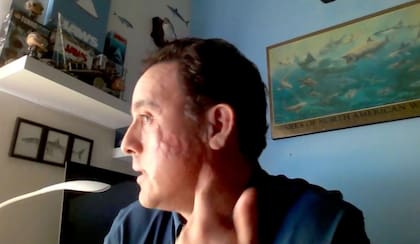 Hoyos lleva con orgullo la cicatriz que le dejó el tiburón. La llama "una marca de batalla que parece branquias".