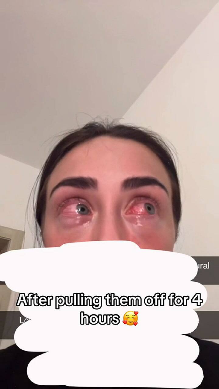 Así fue la reacción alérgica que tuvo una mujer ante las pestañas postizas