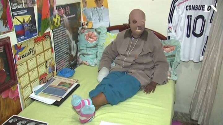 Una mujer colombiana atacada con ácido cancela su eutanasia tras hablar con el Papa