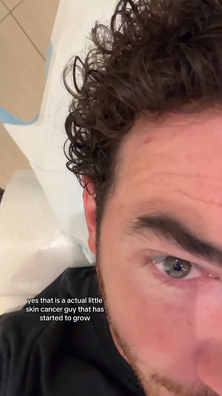 Friendly Reminder To Get Your Moles Checked